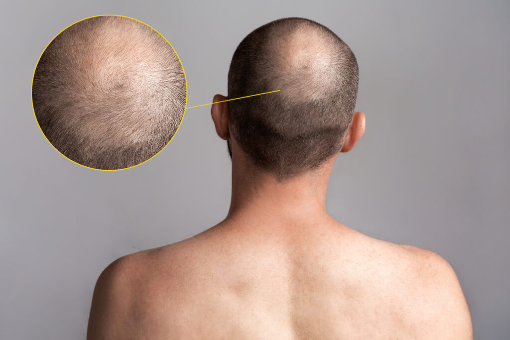 Un hombre visto de espaldas con pérdida de cabello